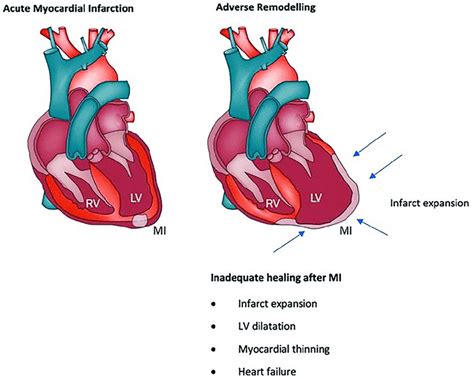 heart lv|enlarged left ventricle life expectancy.